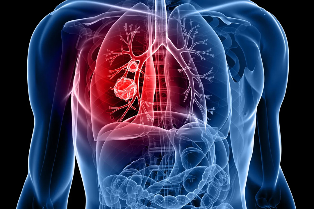 FDA Clears ArkBio to Begin U.S. Trial of Anti‑Fibrotic AK3280